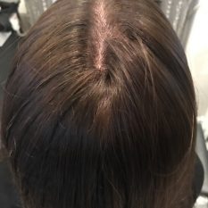 Custom Hair Loss Replacement Integration System