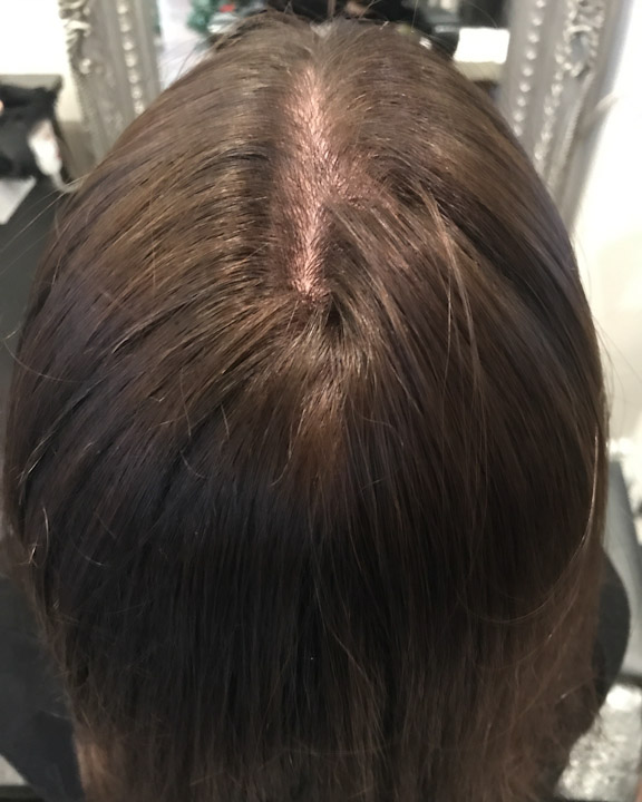 Custom Hair Loss Replacement Integration System