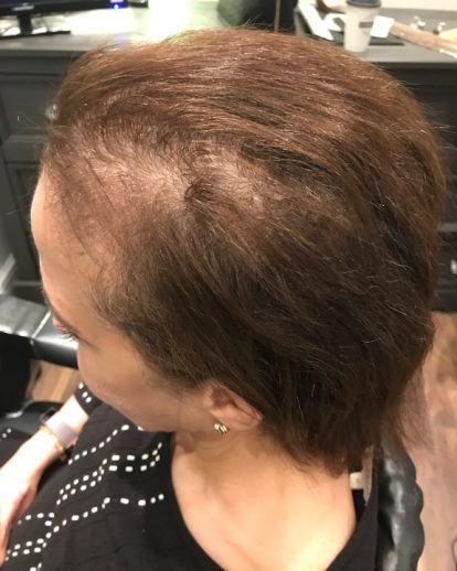 Custom Hair Loss Replacement Integration System