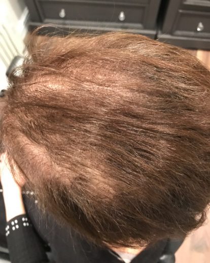 Custom Hair Loss Replacement Integration System