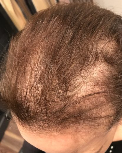 Custom Hair Loss Replacement Integration System