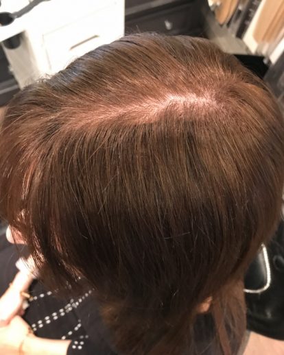 Custom Hair Loss Replacement Integration System